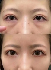 去眼袋手术