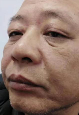 去眼袋手术