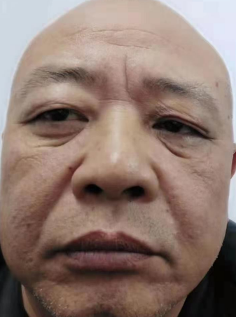 去眼袋手术