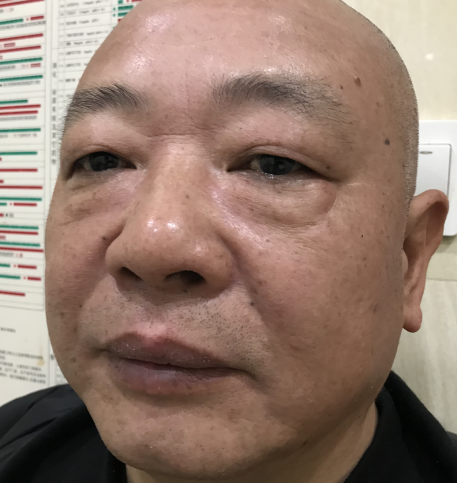 去眼袋手术