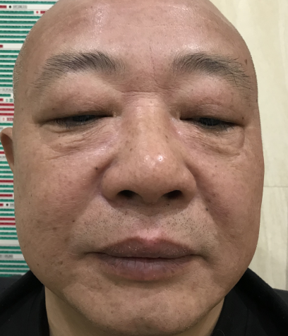 去眼袋手术