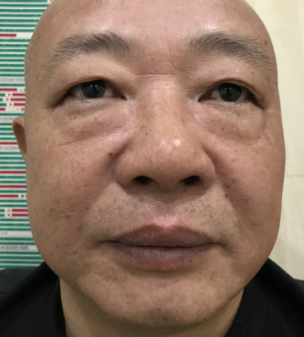 去眼袋手术