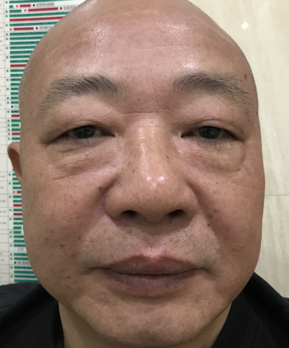 去眼袋手术