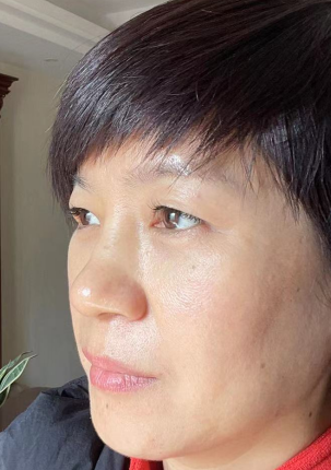 去眼袋手术