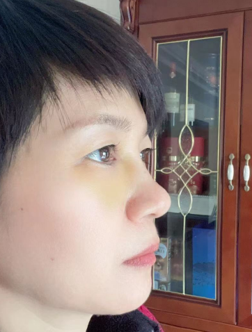 去眼袋手术