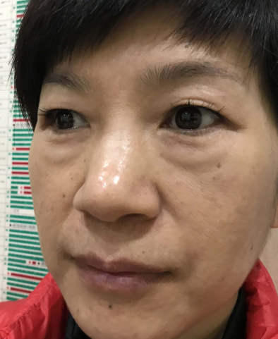 去眼袋手术