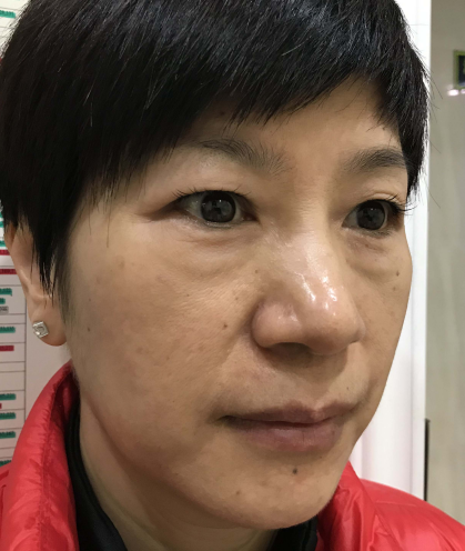 去眼袋手术