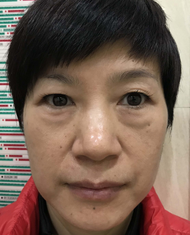 去眼袋手术