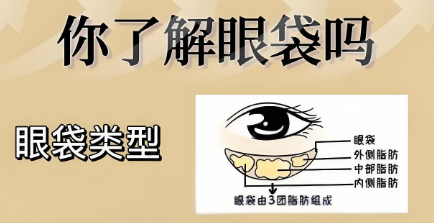 去眼袋手术