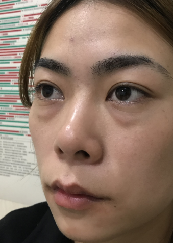 去眼袋手术