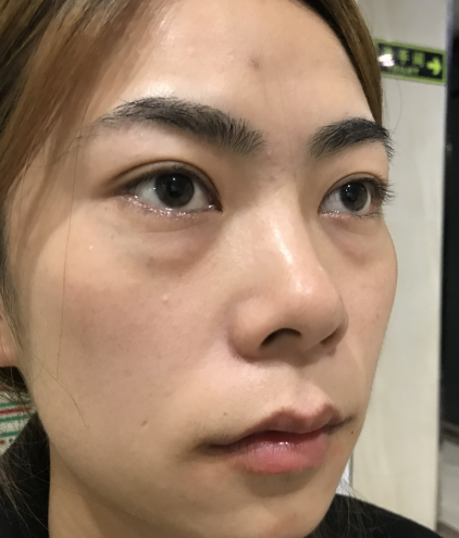 去眼袋手术