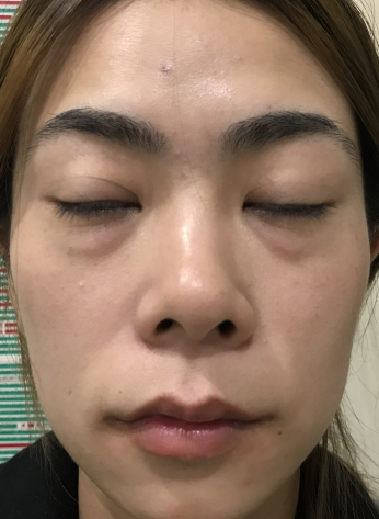 去眼袋手术