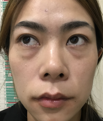 去眼袋手术