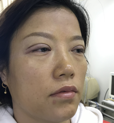 去眼袋手术