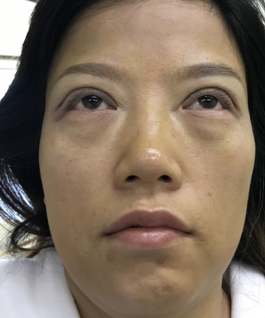 去眼袋手术