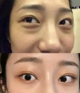去眼袋手术