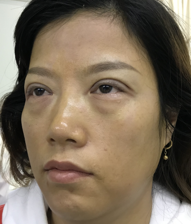 去眼袋手术