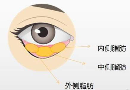 去眼袋手术