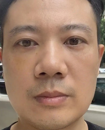 去眼袋手术