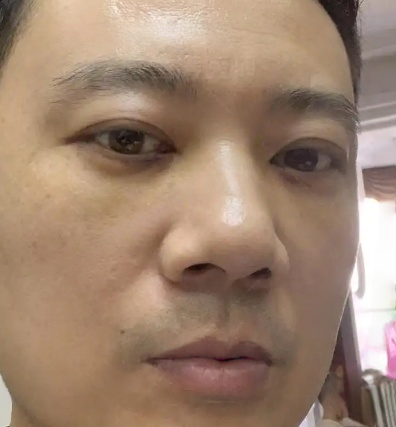 去眼袋手术