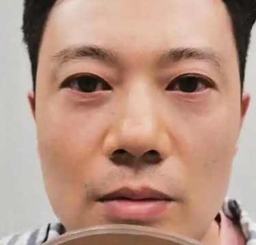 去眼袋手术