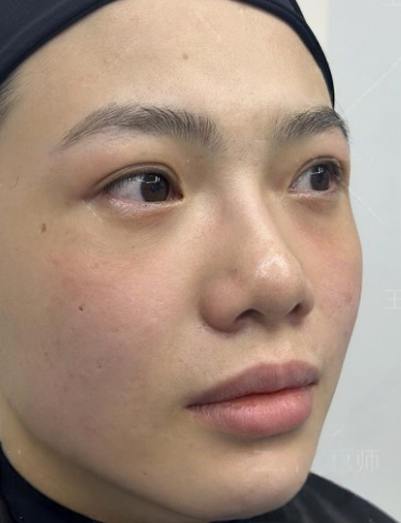 去眼袋手术