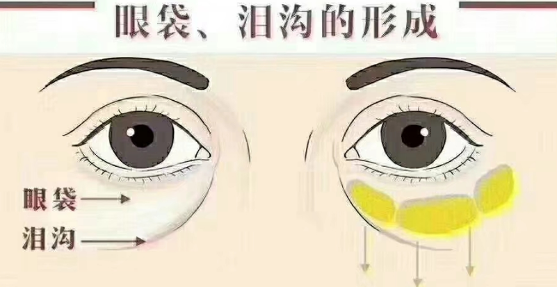 去眼袋手术