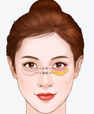 去眼袋手术