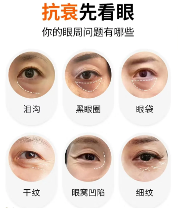 眼袋