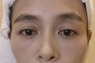 眼袋