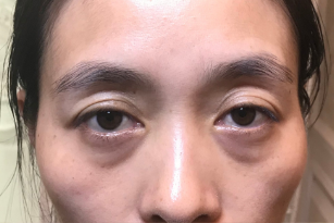 眼袋