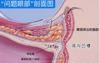 泪沟