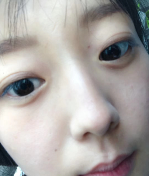 去眼袋手术