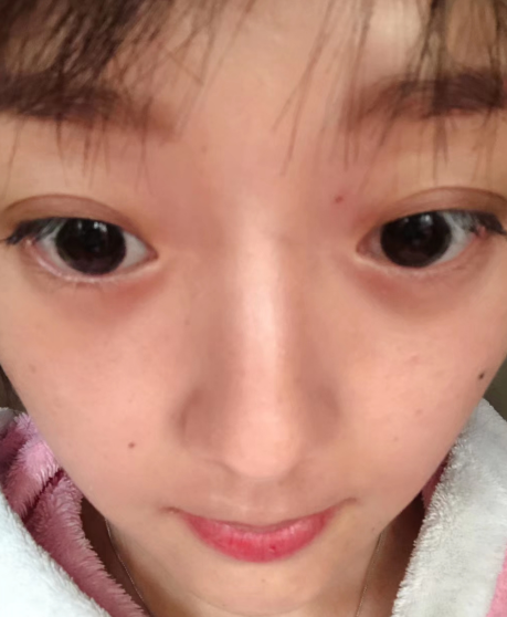 去眼袋手术