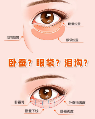 去眼袋手术