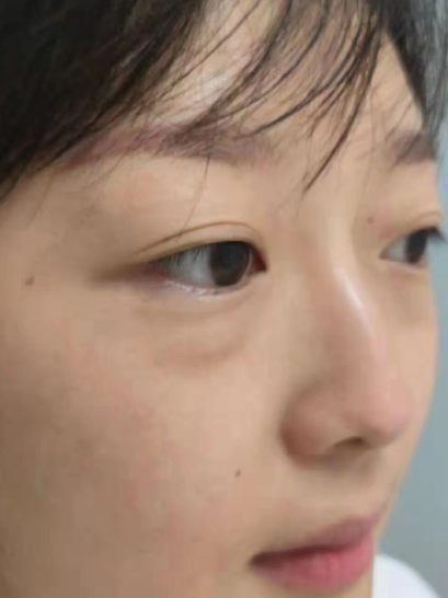 去眼袋手术