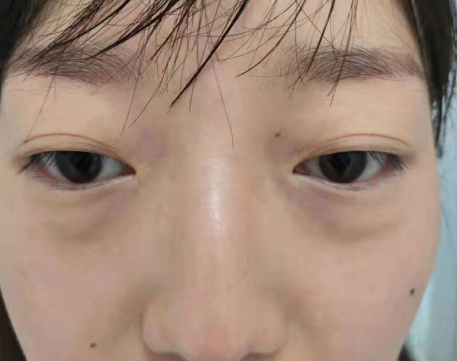去眼袋手术