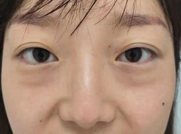 去眼袋手术