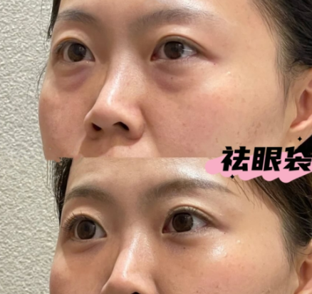 去眼袋手术