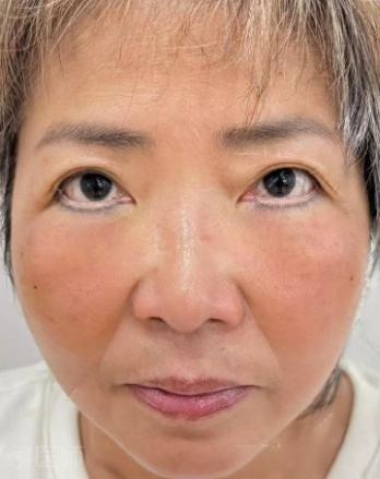 去眼袋手术