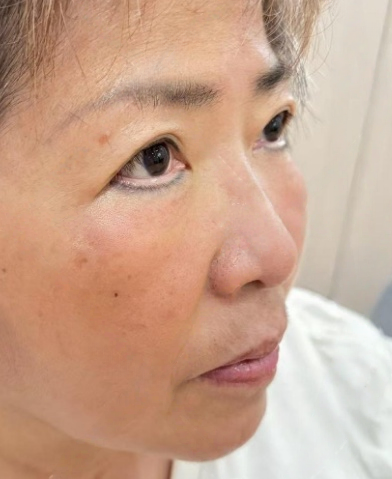 去眼袋手术