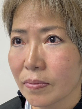 去眼袋手术