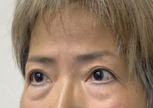 去眼袋手术