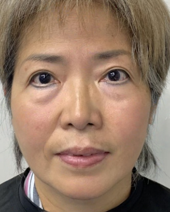 去眼袋手术