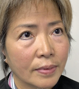 去眼袋手术