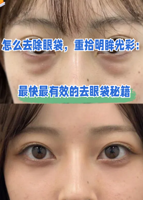去眼袋手术