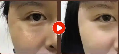 去眼袋手术