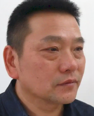 去眼袋手术