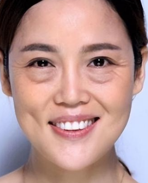 去眼袋手术