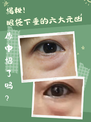 去眼袋手术